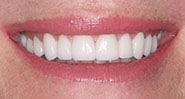 After Image: Case 256 - front