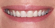 Before Image: Case 256 - front