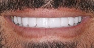After Image: Case 257 - front