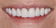 After Image: Case 260 - front