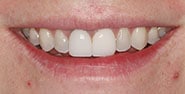Before Image: Case 260 - front
