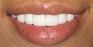 After Image: Case 261 - front