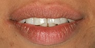 Before Image: Case 261 - front