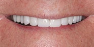 After Image: Case 262 - front
