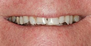 Before Image: Case 262 - front