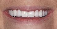 After Image: Case 264 - front