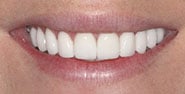 After Image: Case 265 - front