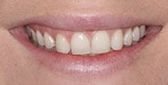 Before Image: Case 265 - front