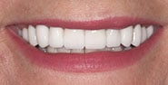 After Image: Case 266 - front