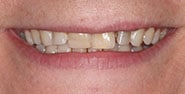 Before Image: Case 266 - front