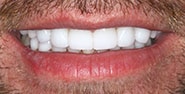 After Image: Case 267 - front