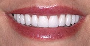After Image: Case 268 - front