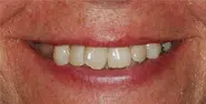 Before Image: Case 27 - front