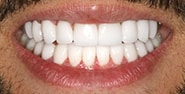 After Image: Case 271 - front