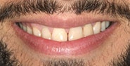 Before Image: Case 271 - front