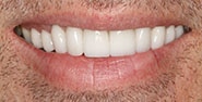 After Image: Case 272 - front