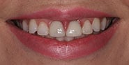 Before Image: Case 274 - front