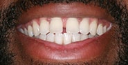 Before Image: Case 275 - front