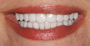 After Image: Case 276 - front