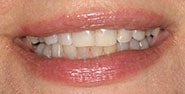 Before Image: Case 276 - front