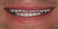Before Image: Case 277 - front