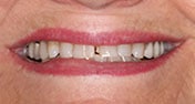 Before Image: Case 278 - front