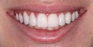 After Image: Case 279 - front
