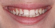 Before Image: Case 279 - front