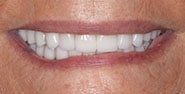 After Image: Case 280 - front