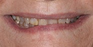 Before Image: Case 280 - front