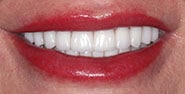 After Image: Case 281 - front