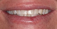Before Image: Case 281 - front
