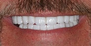 After Image: Case 282 - front