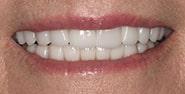After Image: Case 284 - front
