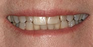 Before Image: Case 284 - front