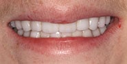 After Image: Case 287 - front