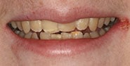 Before Image: Case 287 - front