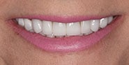 After Image: Case 288 - front