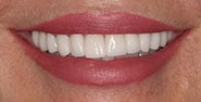 After Image: Case 289 - front