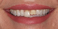 Before Image: Case 289 - front