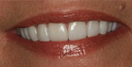 After Image: Case 29 - front