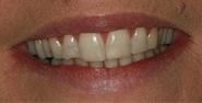Before Image: Case 29 - front