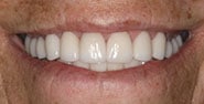 After Image: Case 290 - front