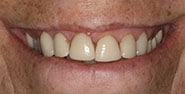 Before Image: Case 290 - front