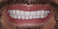 After Image: Case 291 - front