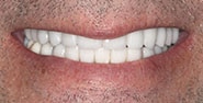 After Image: Case 292 - front