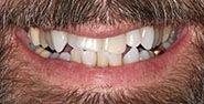 Before Image: Case 292 - front