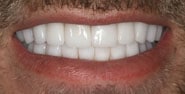 After Image: Case 293 - front