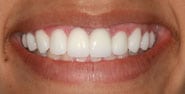 After Image: Case 294 - front