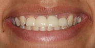 Before Image: Case 294 - front